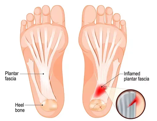 Plantar-Fascitis