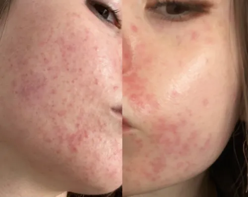 very inflamed and puffy skin