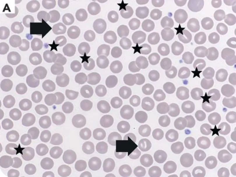 xerocytosis