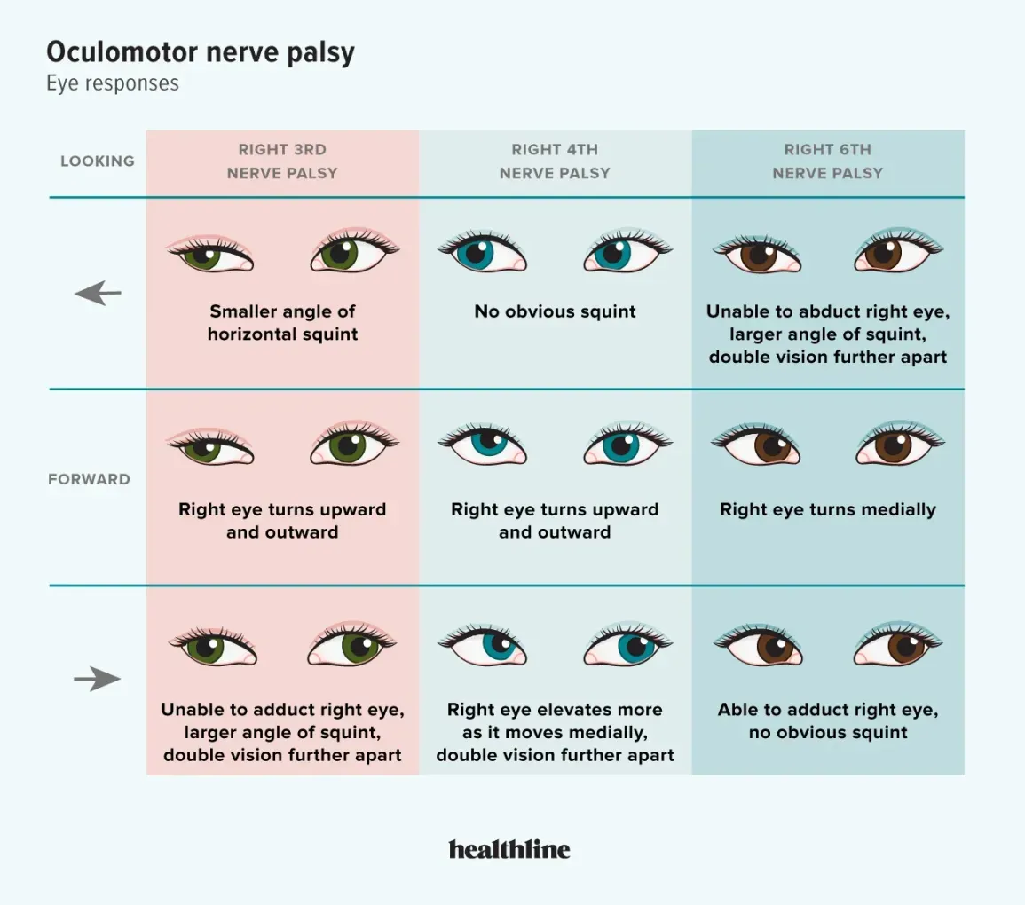 2449493-what-is-oculomotor-nerve-palsy-1296x1145-slide-2