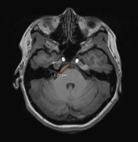tumor measurement