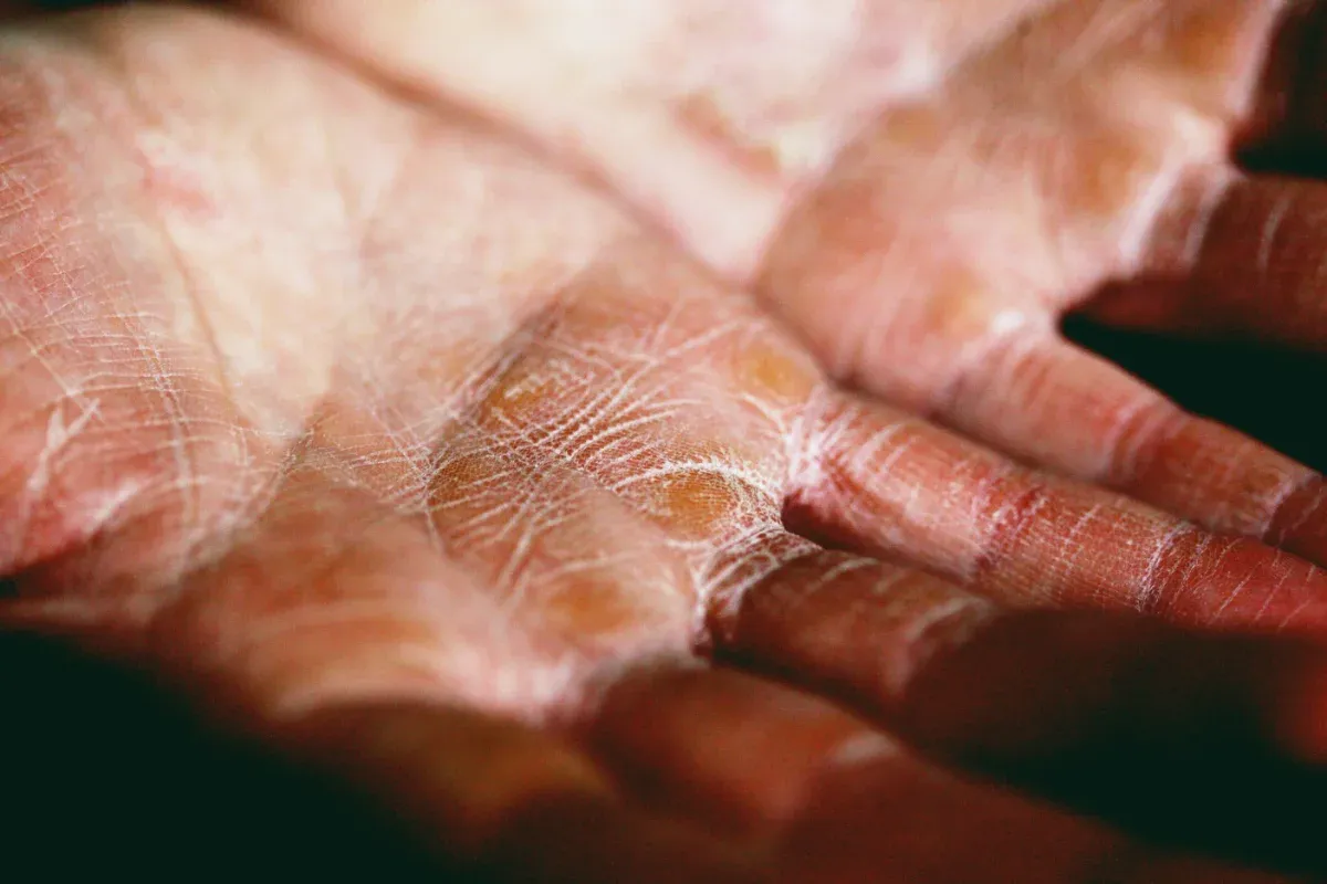 Chaffed Working Hands