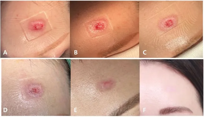 Sequential wound healing following injectable PN treatment