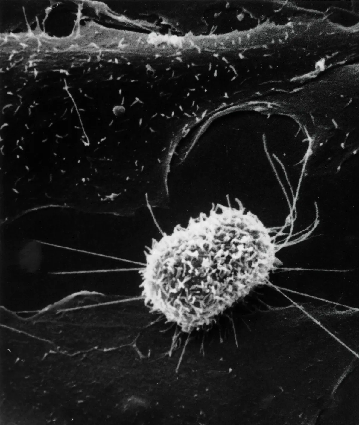 Cancer cell under a microscope