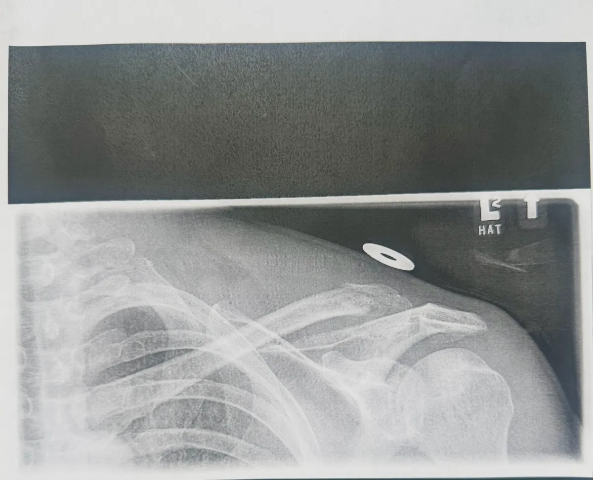 Collarbone x-ray