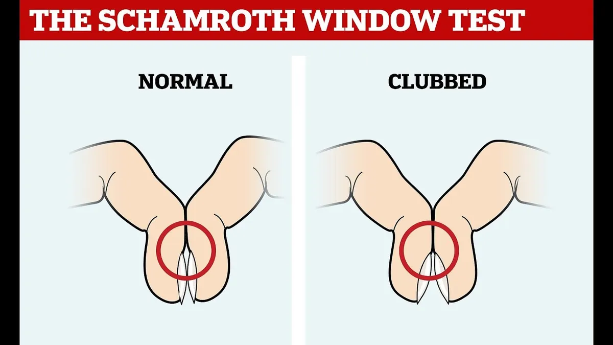 Schamroth's window test