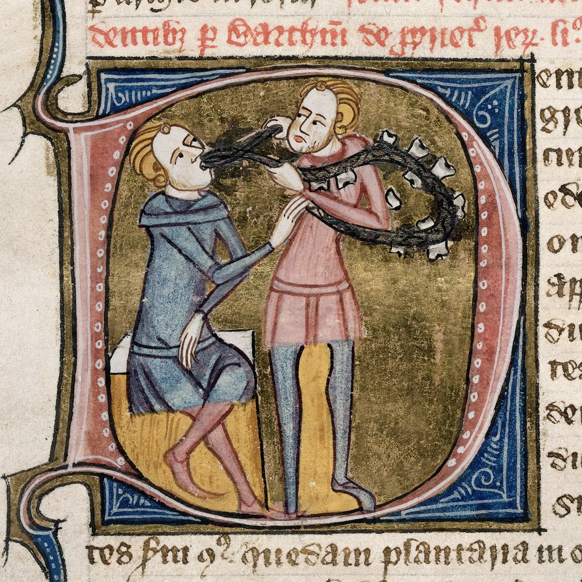 A medieval dentist extracting a tooth from the Omne Bonum encyclopedia.
