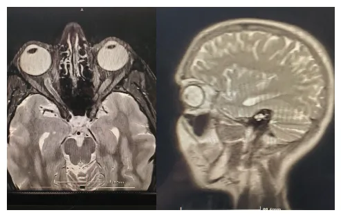 2 photos d'un IRM d'un cerveau en bonne santé. La photo de gauce est une vue depuis le haut, en coupe au niveau des globes oculaires, on y voit le cerveau, les yeux et les sinus. La photo de droite est une vue depuis le coté, en coupe au niveau d'un des yeux. On y voit le profil de la personne, son oeil et son cerveau.
