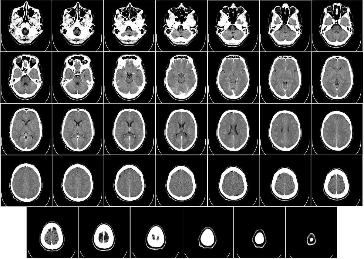 Computed_tomography_of_human_brain_-_large