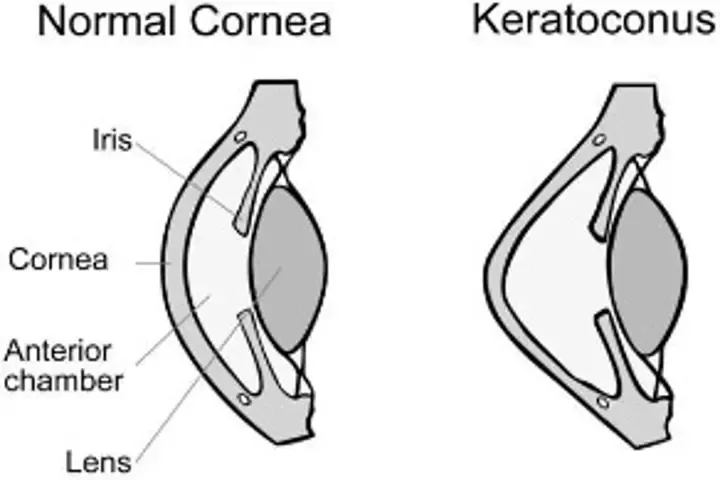 keratoconus cornea
