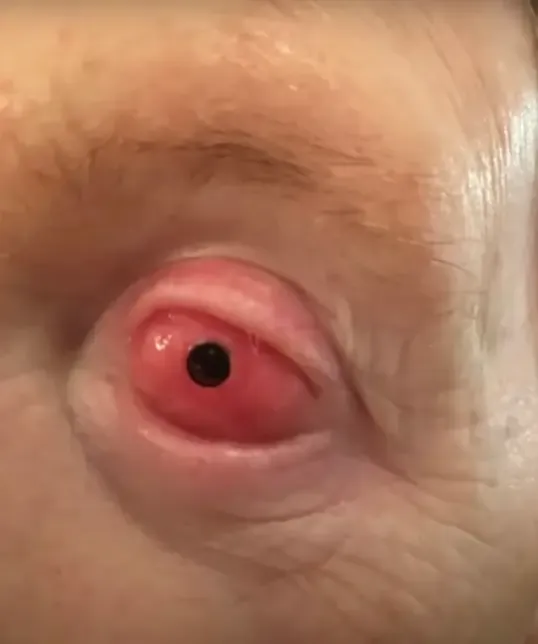 Eye Tooth